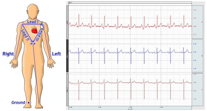 ecg-3-lead-recording-la-union-medical-diagnostic-center-and-hospital